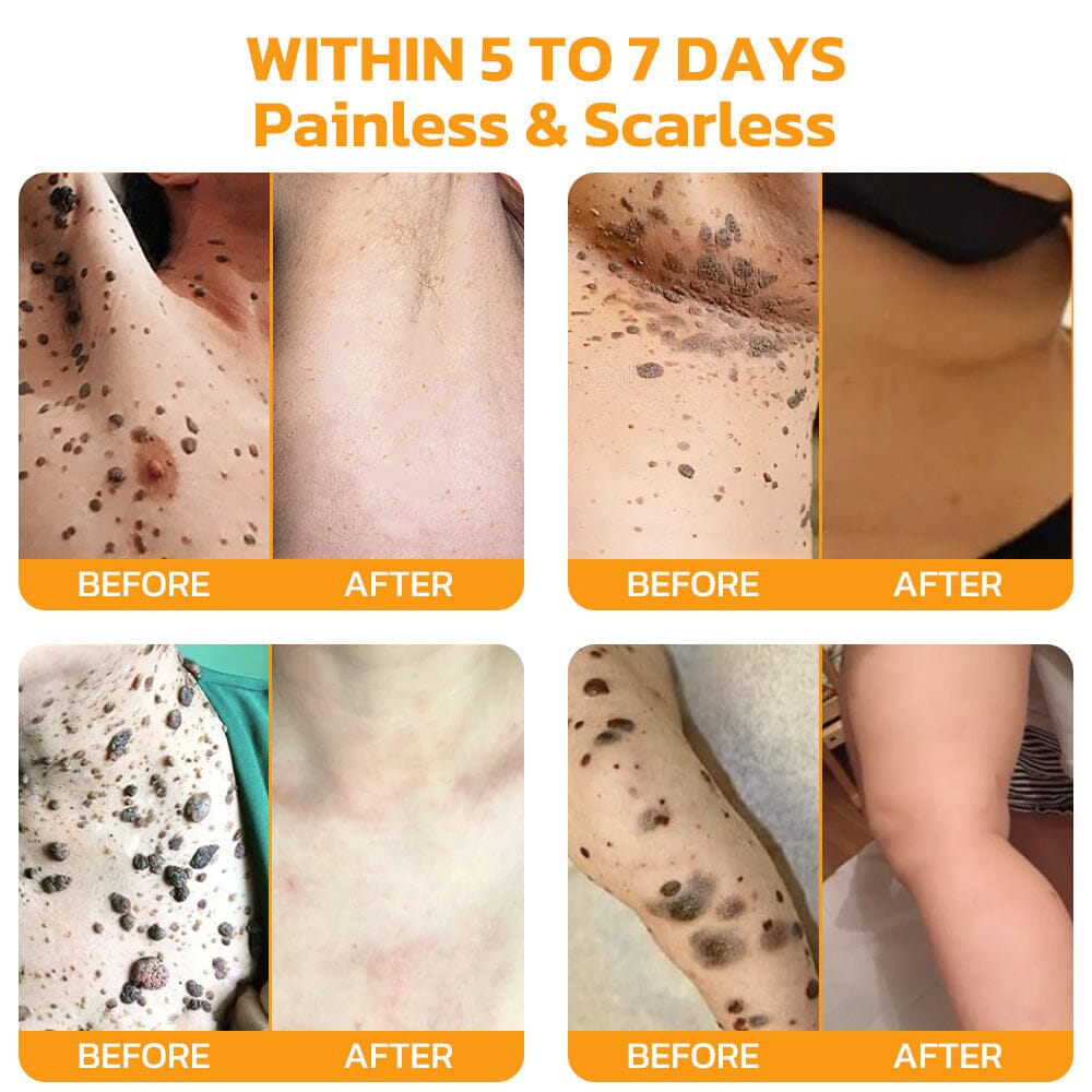 Therapeutic Goods Administration (TGA)✅ Furzero™ Bee Venom Skincare Treatment Pads (⚕️AAD Recommended)