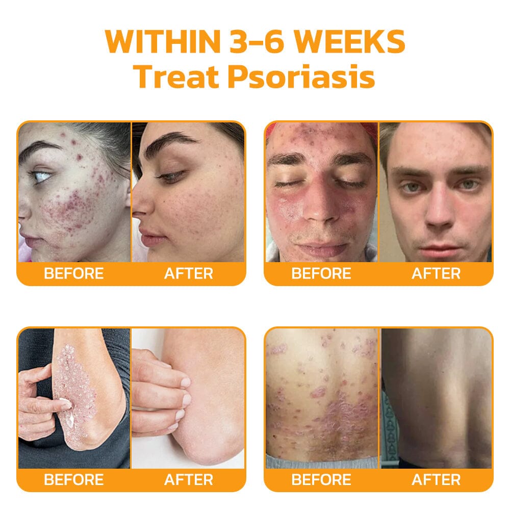 Therapeutic Products Directorate (TPD)✅ Furzero™ Bee Venom Skincare Treatment Pads (⚕️AAD Recommended)