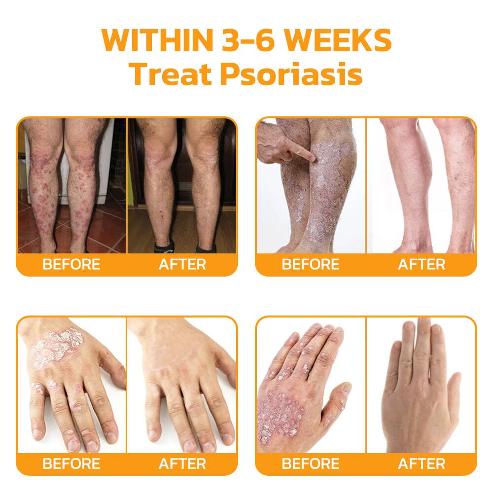 Therapeutic Goods Administration (TGA)✅ Furzero™ Bee Venom Skincare Treatment Pads (⚕️AAD Recommended)